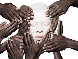 Albinism and Skin Cancer