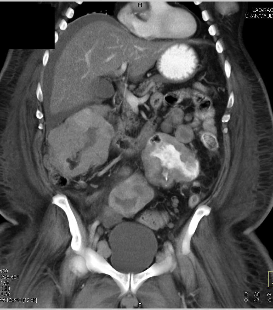 Biopsy Testing for Melanoma