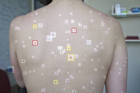 Bringing Melanoma Detection Closer to the Community